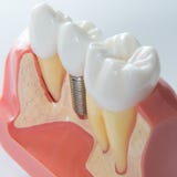 Dental implant Stock Image