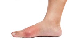 Foot with inflamed gout Royalty Free Stock Photo