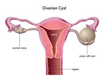 Ovarian cyst Royalty Free Stock Image